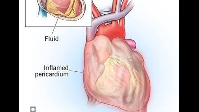 Acute & Recurrent Pericarditis-VCU School of Medicine