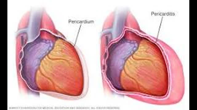 Recurrent Pericarditis -  - UNIV OF MICHIGAN