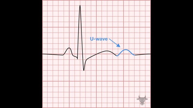 Hypokalemia_Algorithm
