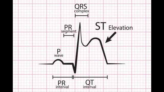 STEMI Mimics You've Got to Know