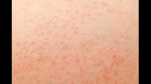 Petechial Skin Rash in a pregnant woman