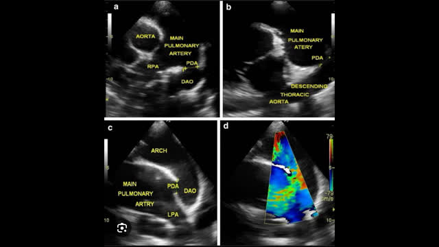 How to  approach this patient with a machinery murmur ?