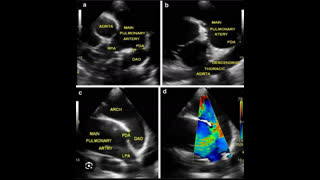 How to  approach this patient with a machinery murmur ?