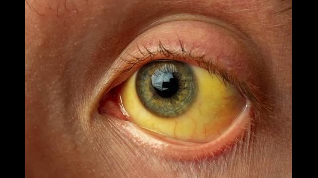 Obstructive_Jaundice_Grand_Rounds_Case_v3