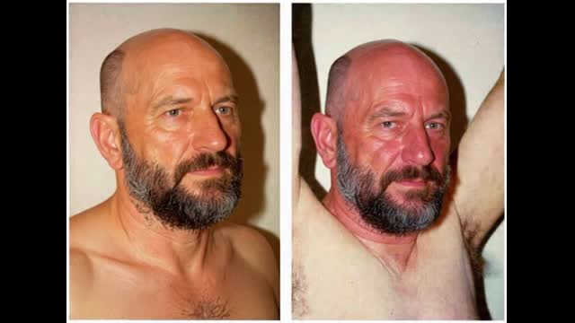 What is the diagnosis of this patient with facial redness?