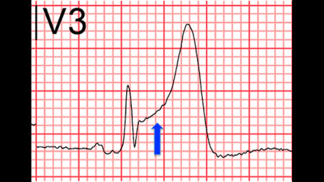 STEMI Complication Uncovered
