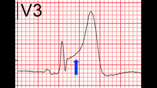 STEMI Complication Uncovered