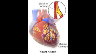 STEMI Complication Uncovered