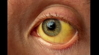 Autoimmune_Pancreatitis_Board_Review_Quiz