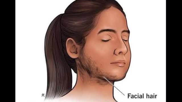 35 year old lady with new onset virlisation