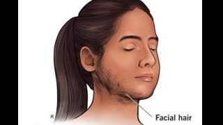 35 year old lady with new onset virlisation