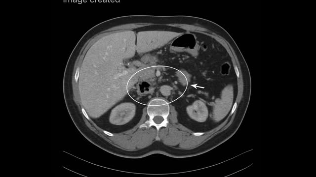 Medical_Management_Necrotizing_Pancreatitis_Colored