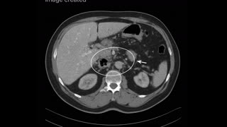 Medical_Management_Necrotizing_Pancreatitis_Colored