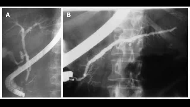 Gallstone_Pancreatitis_ERCP pathway